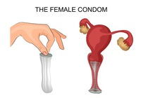 Female Condom